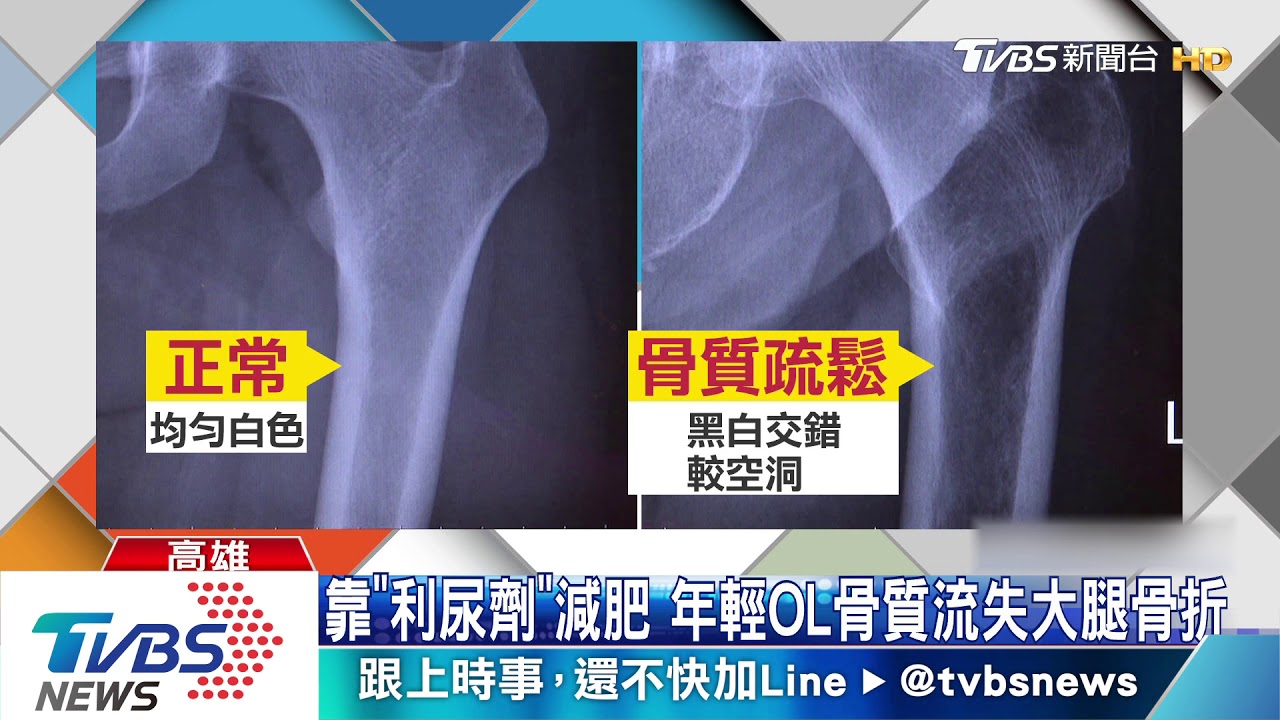 靠「利尿劑」減肥　 年輕OL骨質流失大腿骨折