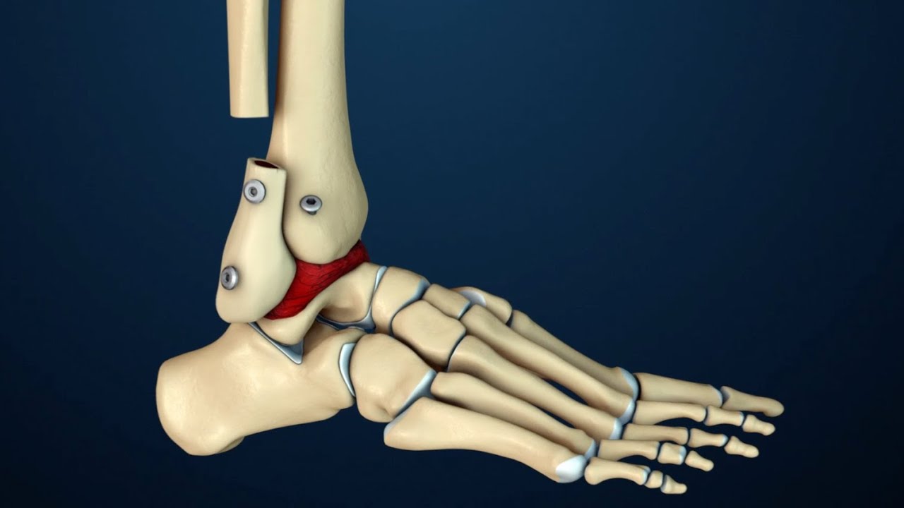 Arthrodesis | Transfibular Ankle Fusion Surgery | Nucleus Health