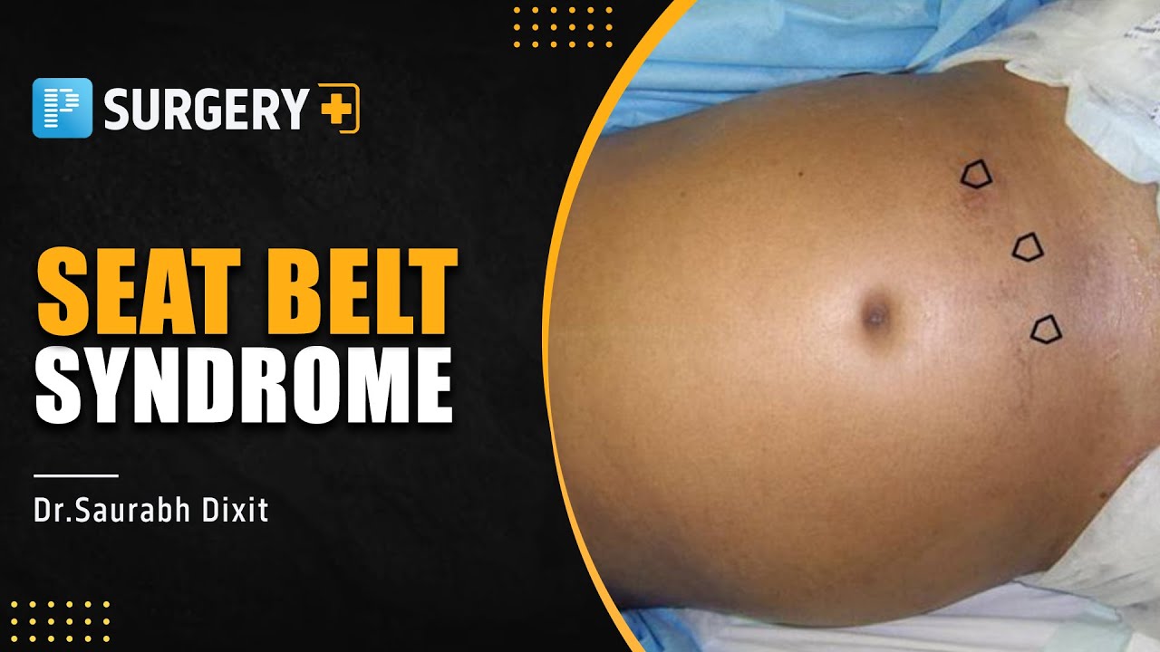 Seat belt Syndrome from Surgery by Dr. Saurabh Dixit - PrepLadder NEET SS