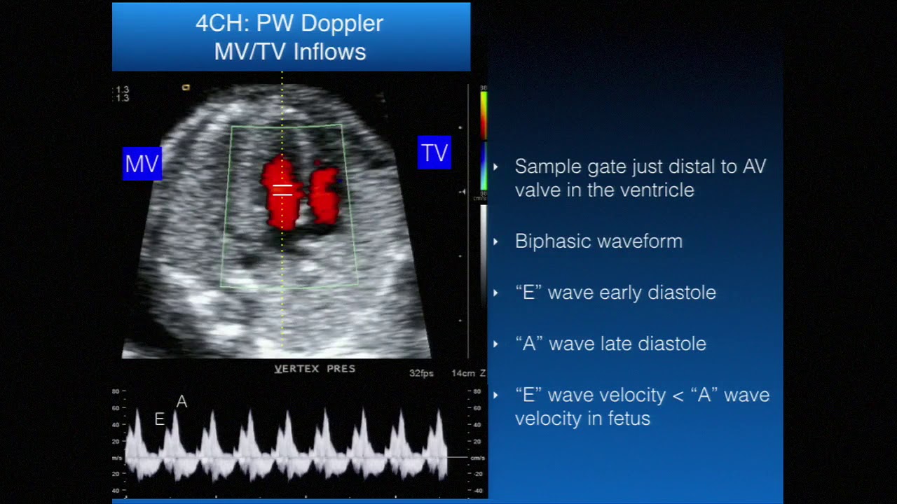 Basic Fetal Echocardiography