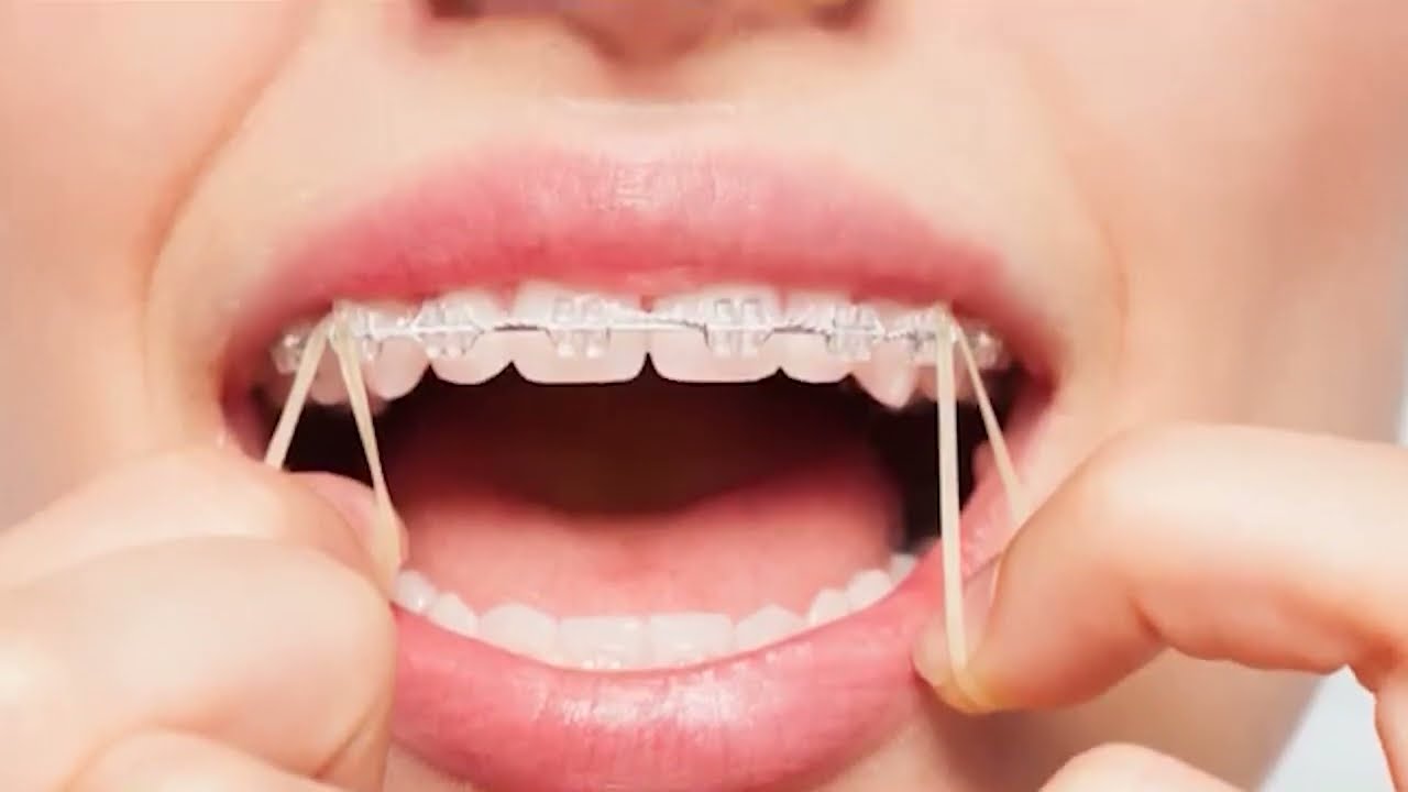 Gummy Smile - Upper Jaw Surgery Post Operation - Lefort 1 Osteotomy - Reconface