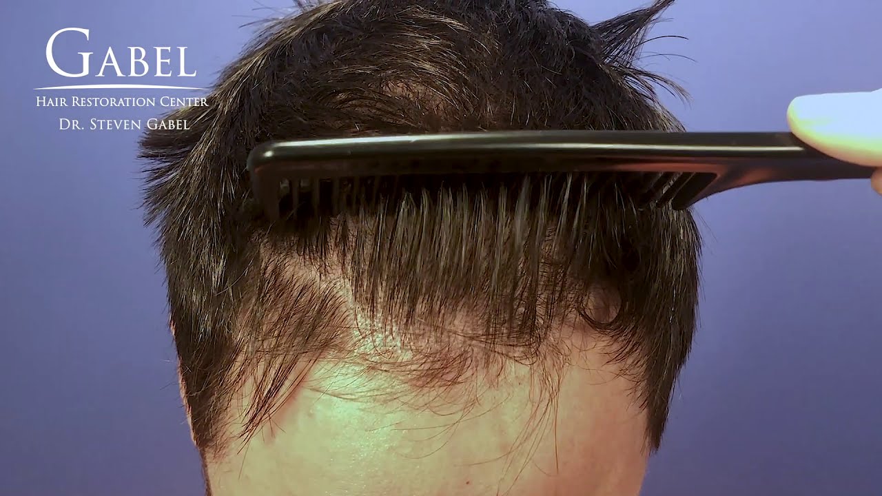 Graft Hair Transplant | Dr. Steven Gabel | Portland, OR