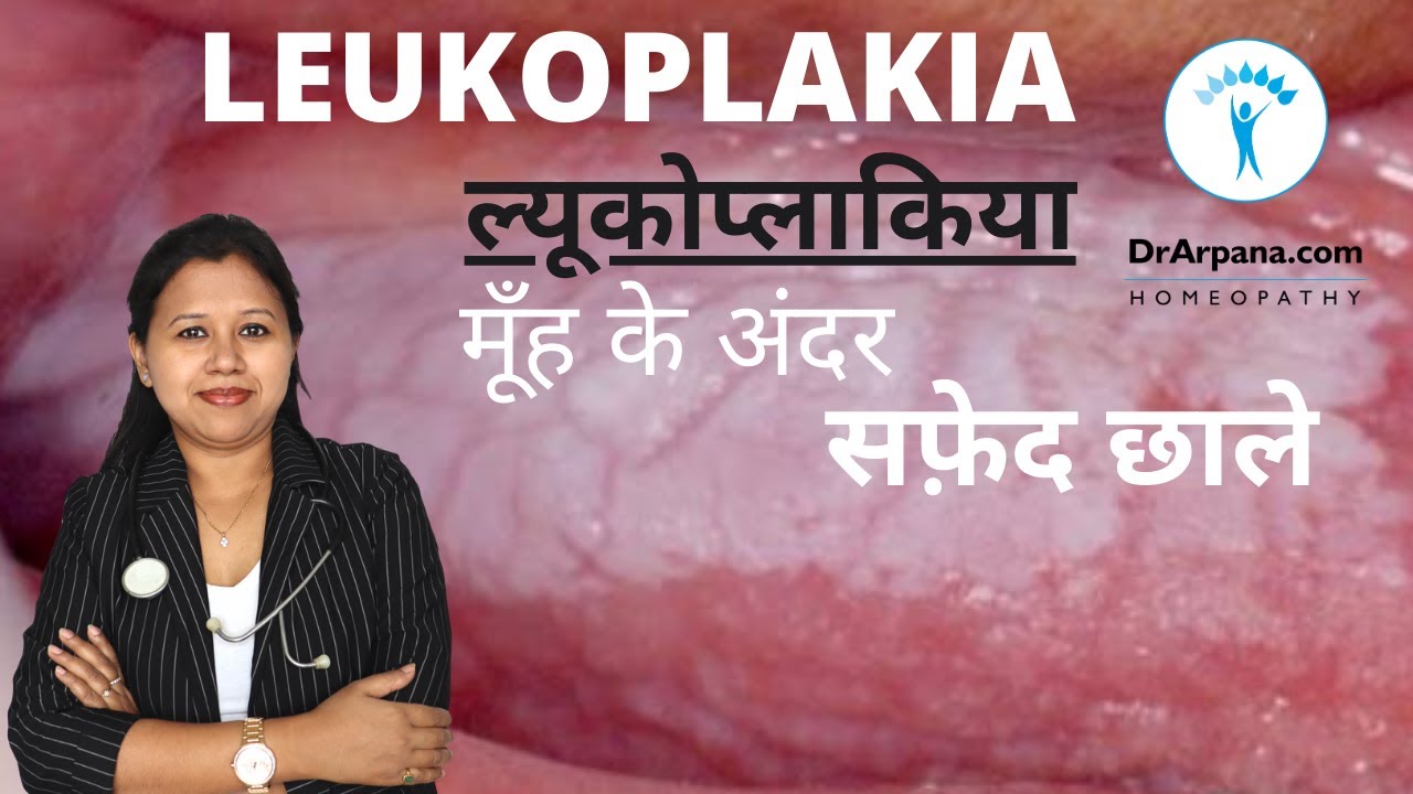 मूँह के अंदर सफ़ेद छाले LEUKOPLAKIA