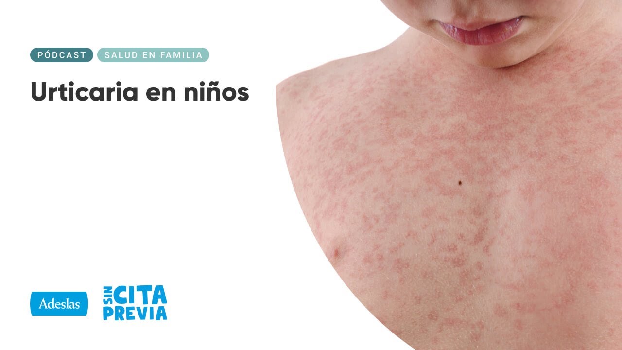 Urticaria en niños | Ep. 03x27