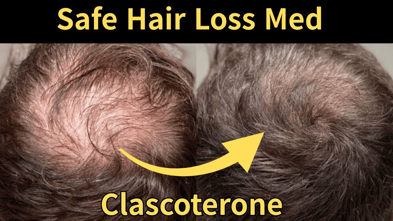 Clascoterone (Breezula): The First Safe Hair Loss Medication
