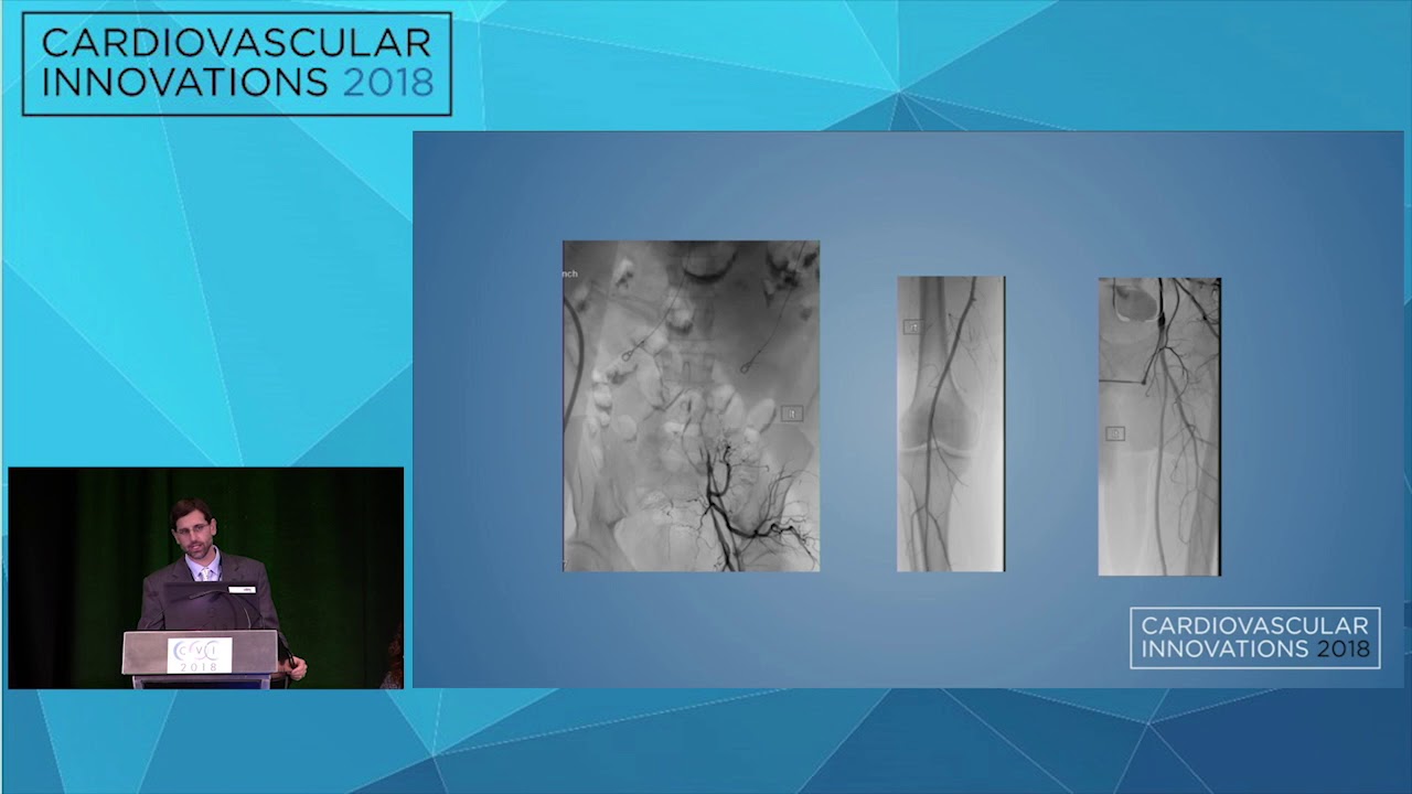 CVI2018 Session: My worst aortoiliac complication - Christopher Huff, MD