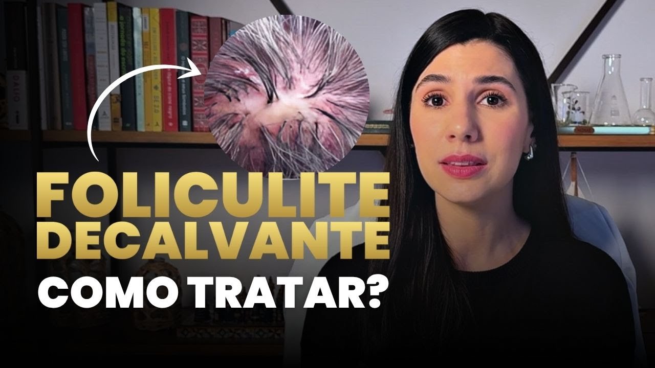 Foliculite Decalvante tem cura? Entenda a causa, os sintomas e o tratamento