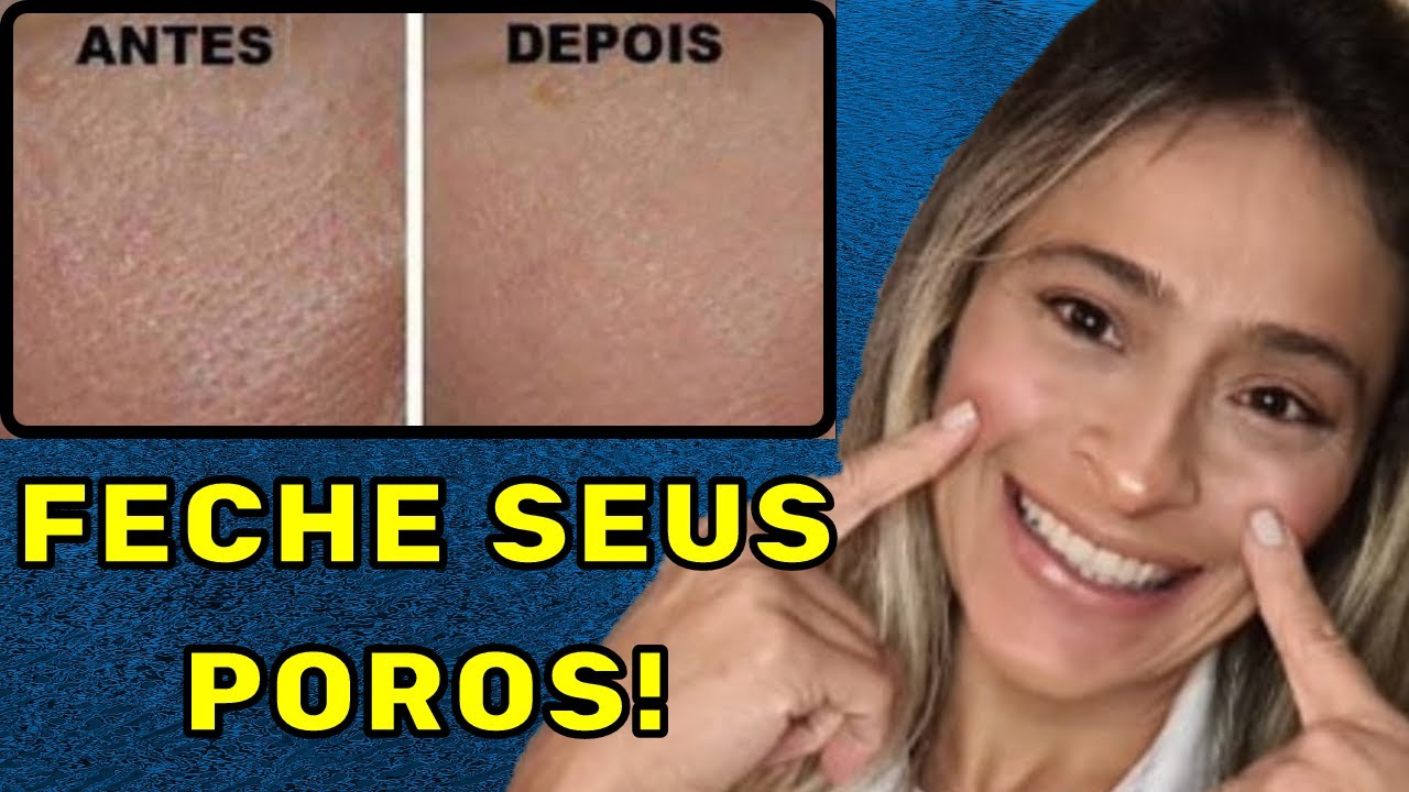 Toda Verdade sobre POROS Abertos e Dilatados! E o que fazer para Minimizá-los!