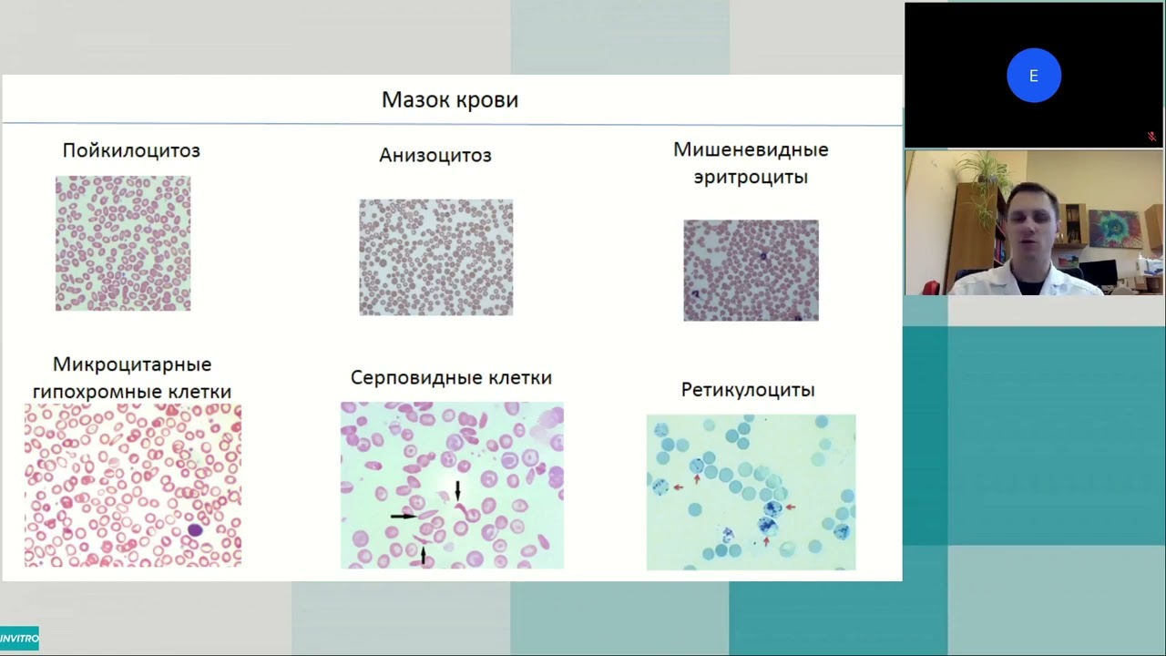 Диагностика талассемий и гемоглобинопатий