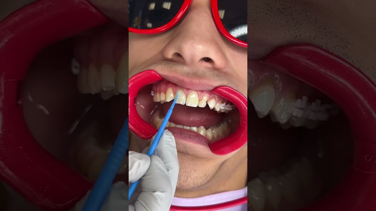Putting on LightForce 3D Custom Braces