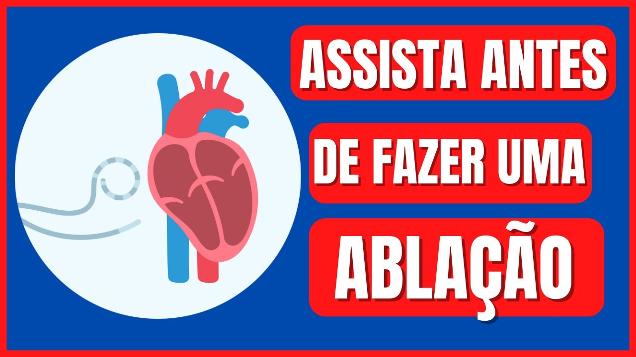 6 DICAS IMPORTANTES ANTES DE FAZER ABLAÇÃO POR CATETER DE ARRITMIAS CARDÍACAS - DR. FELIPE SOUZA