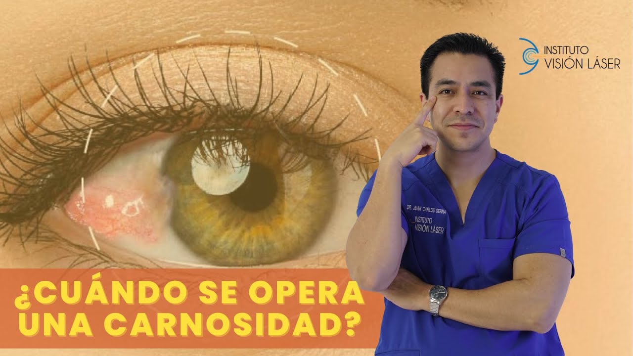 &iquest;CU&Aacute;NDO SE OPERA UNA CARNOSIDAD?