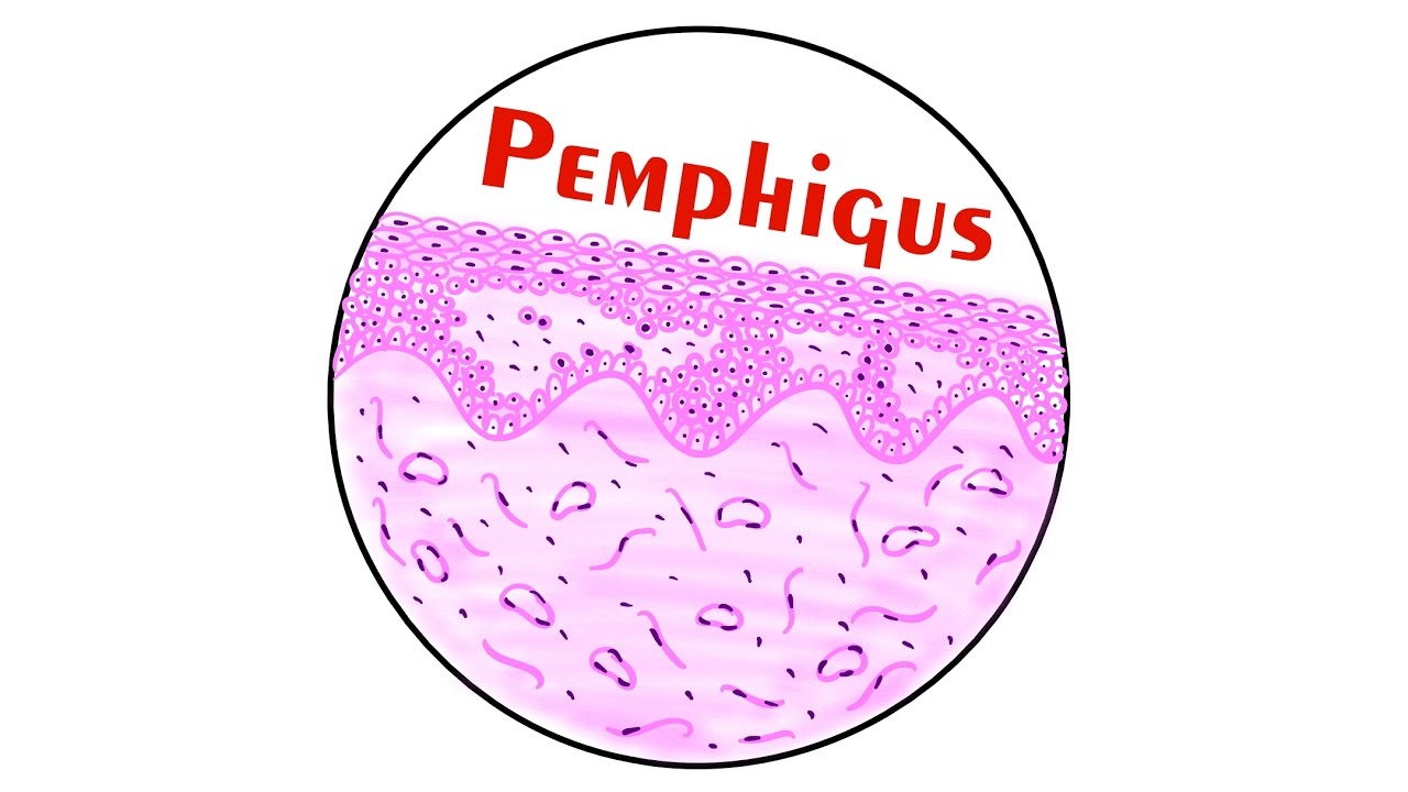 Pemphigus : Histopathology