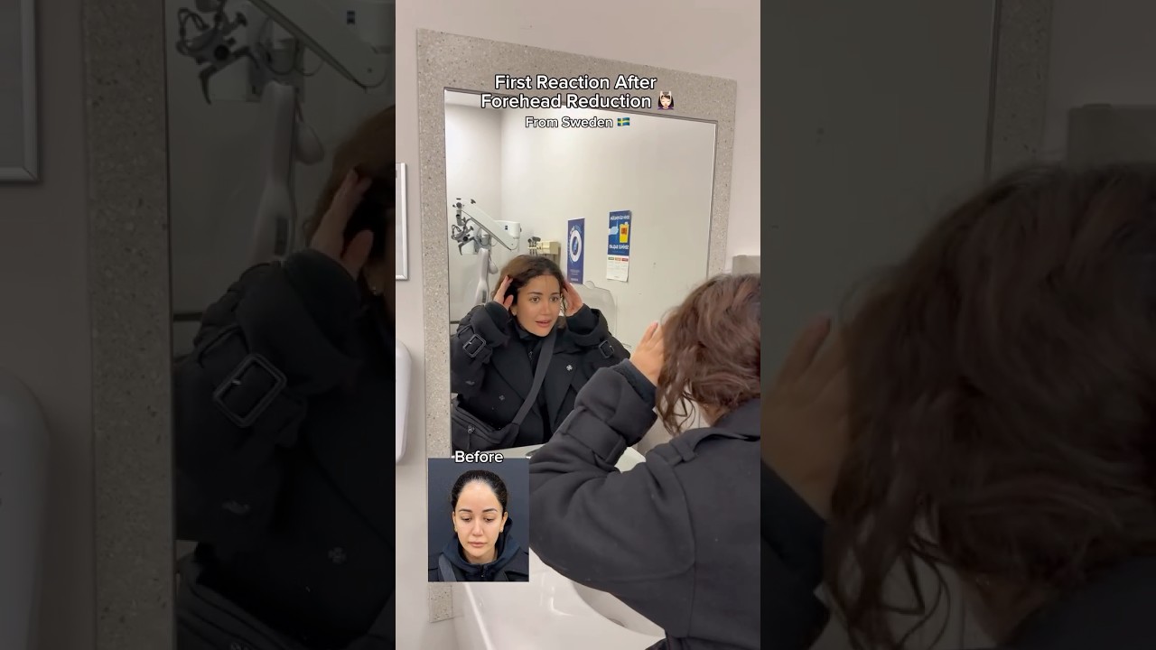 Forehead Reduction 💆🏻‍♀️ Dr. Ahmet Dilber ✨ 