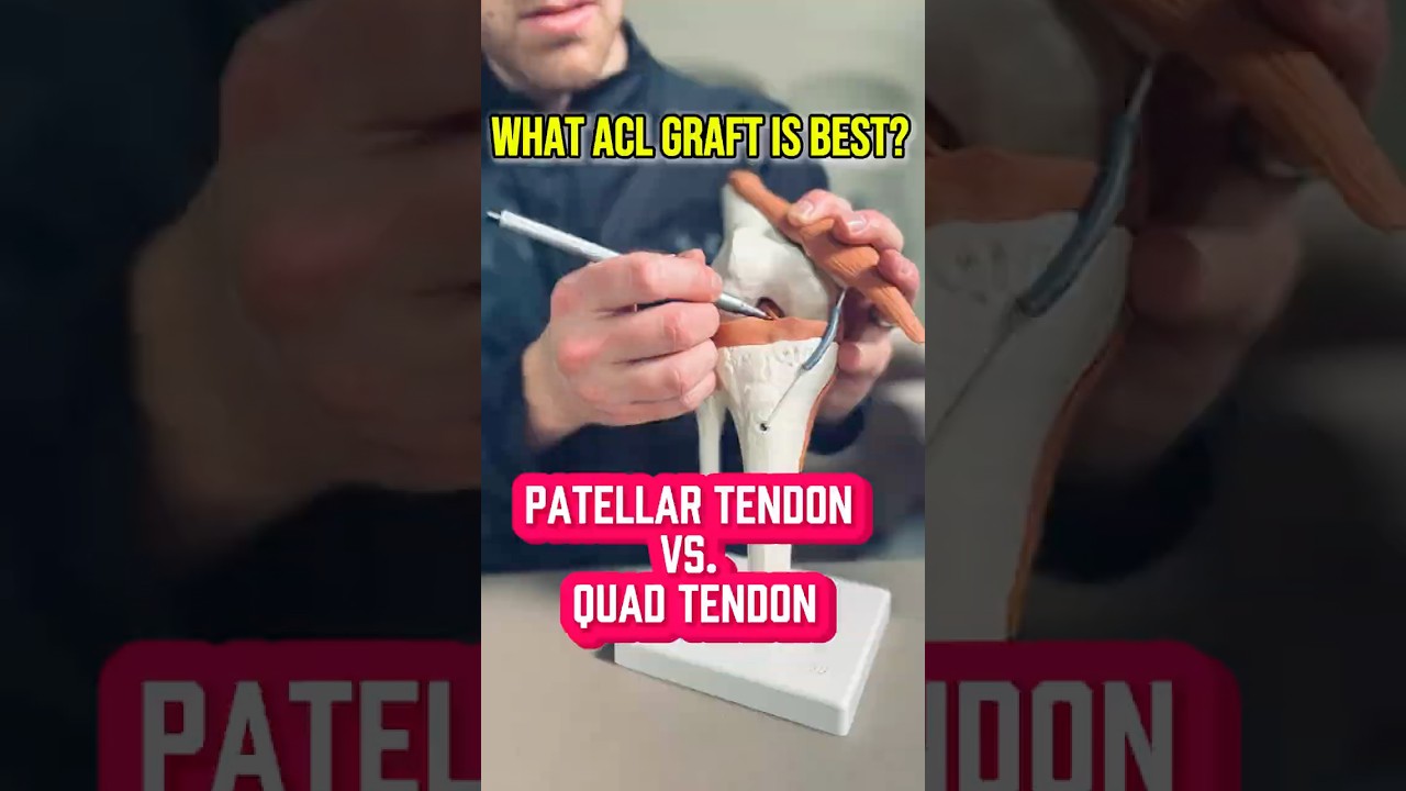 Choosing the Right ACL Graft - Full Breakdown!