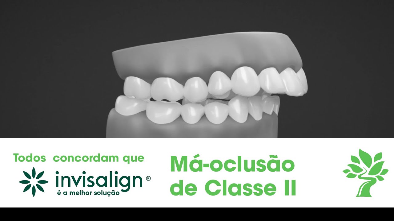 Invisalign é eficaz para Má-oclusão de classe II? | Ortocia