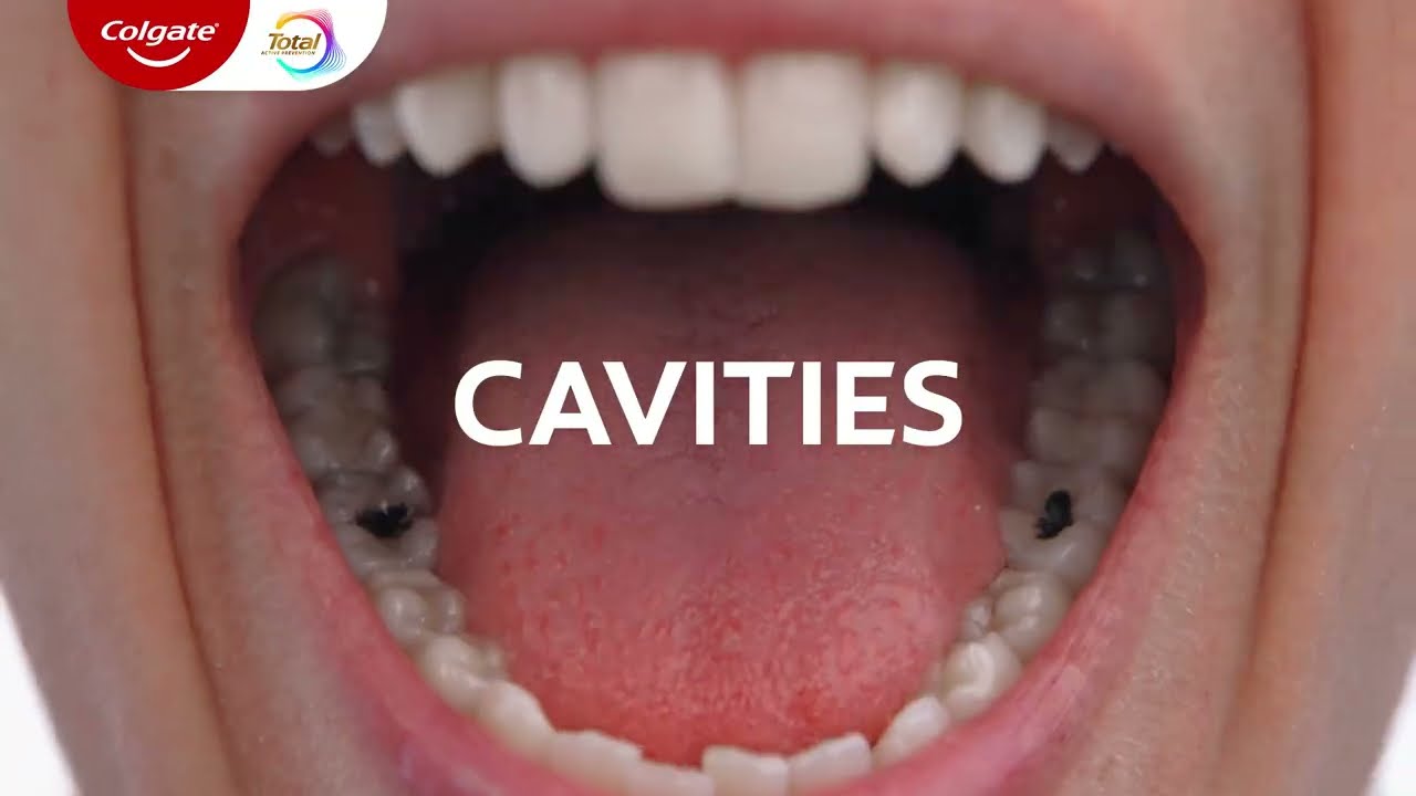 Get ahead of cavities with Colgate Total!
