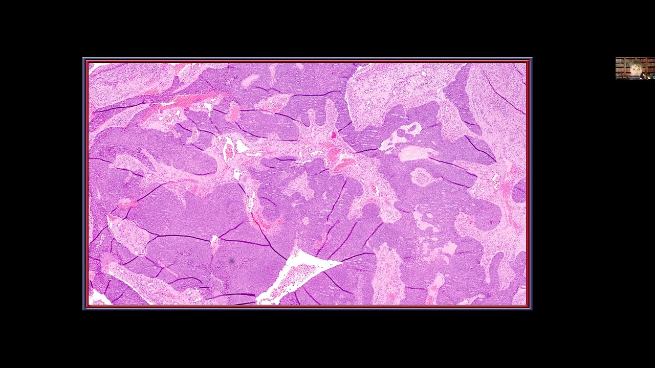 2022 07 25 Differentials for Small Round Blue Cell Tumors of the Sinonasal Tract