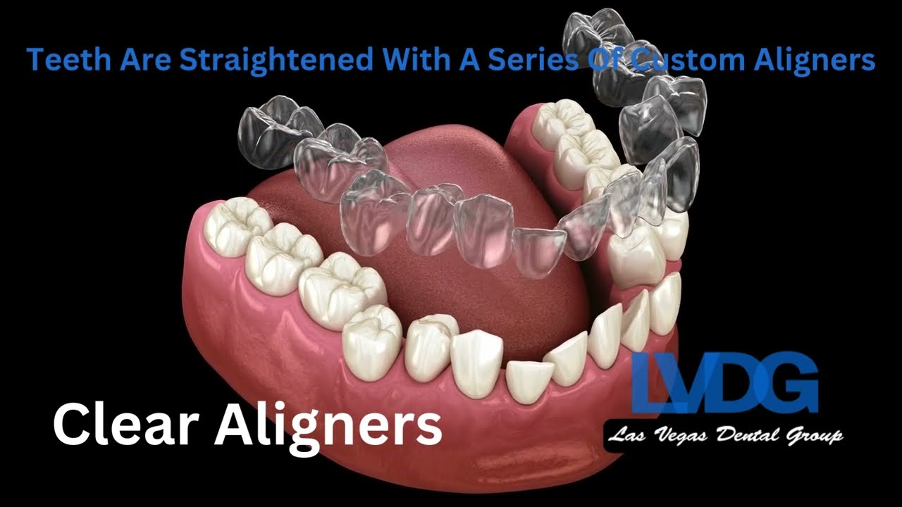 Clear Aligners Invisalign Las Vegas Dental Group | Straighter Teeth With Clear Aligners LVDG
