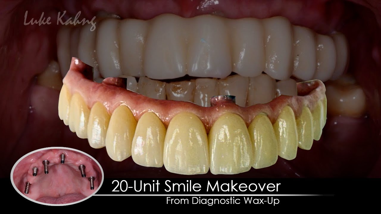 20-Unit Smile Makeover from Diagnostic Wax-Up