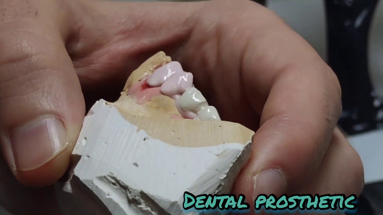İMPLANT ÜSTÜ PROTEZ NASİL YAPILIR ?  #Dentalprosthetic #Disprotez #dentist #clinic #saglik #estetik