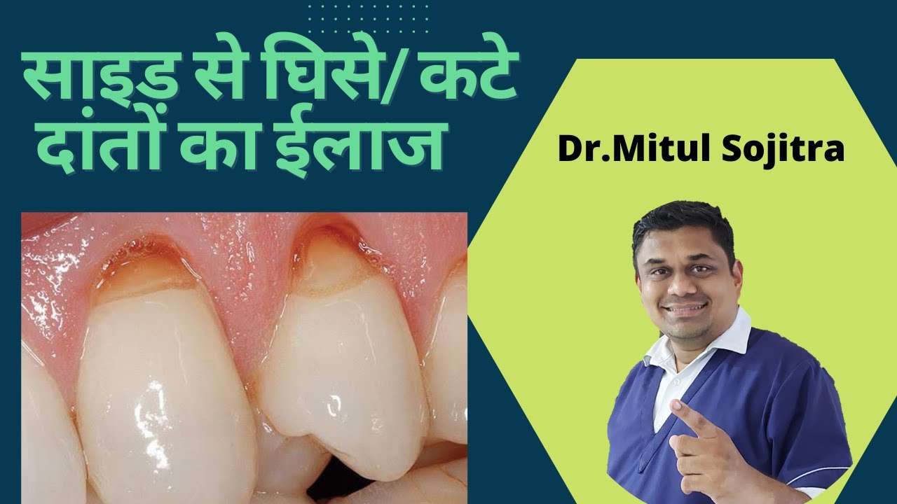 साइड से घिसे हुए दांत का इलाज || Ghise Hue Dant Ka ilaj || Prevention Strategy ||