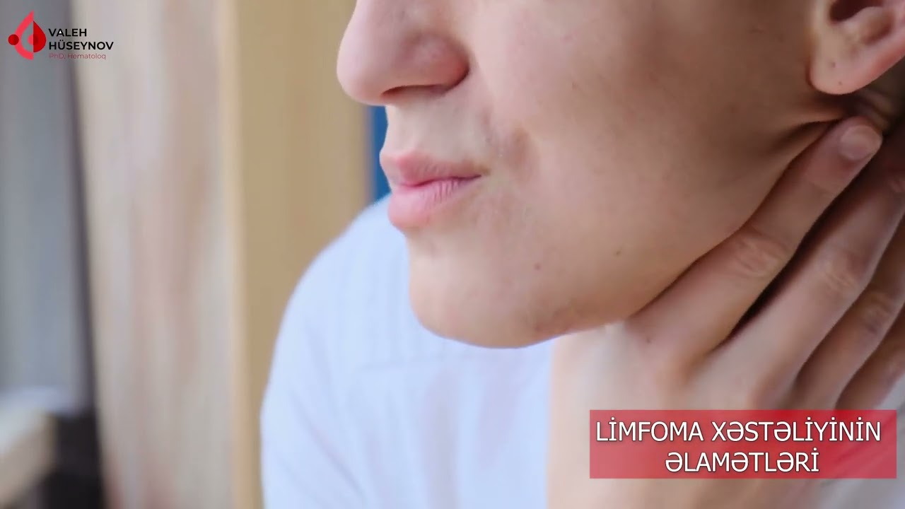 Limfoma xəstəliyinin əlamətləri hansılardır?
