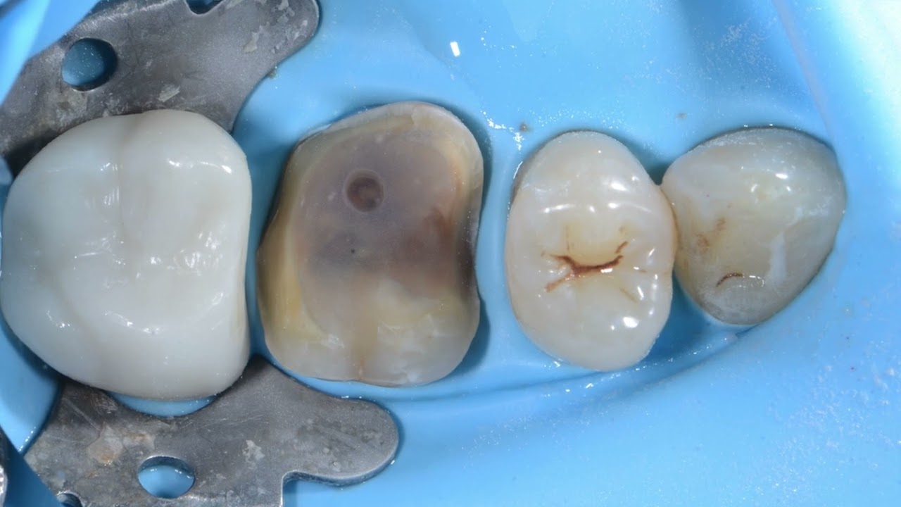 Dr. Kevin Anderson talks about the Calset Composite Warmer