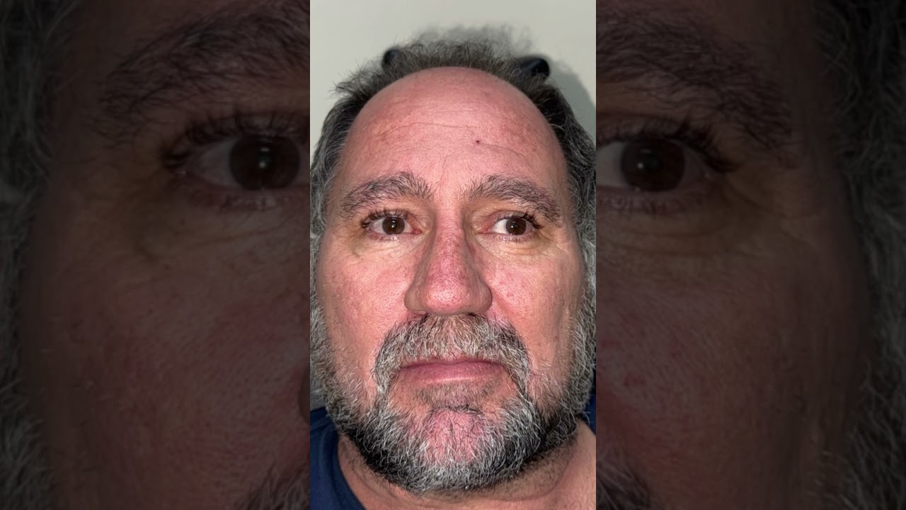 How to treat a Exotropia squint with prisms and Visual Therapy #Prisms #Exotropia #VisionTherapy
