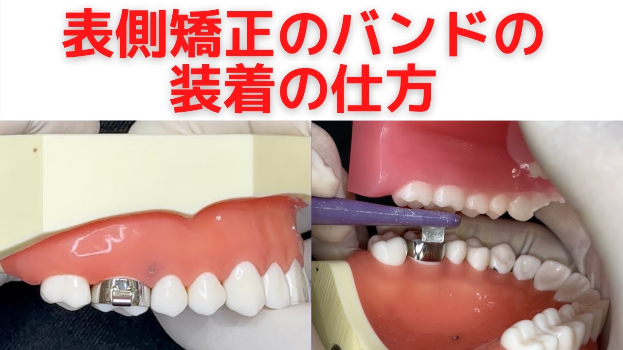 【表側矯正のバンド装着の様子】模型で矯正歯科医が解説