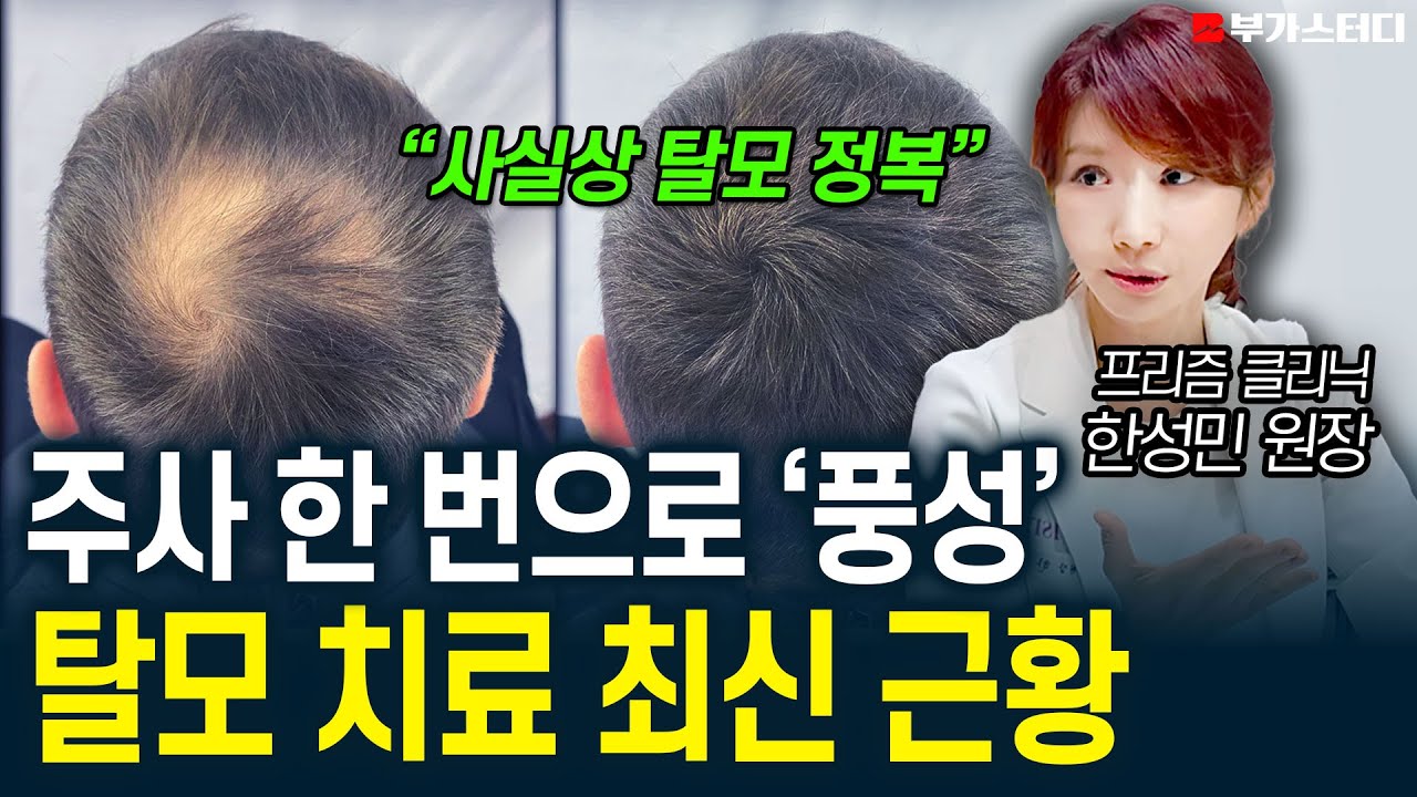 '죽은 모발이란 건 없었습니다' 진료 한 번으로 끝나는 탈모 치료 최신 근황
