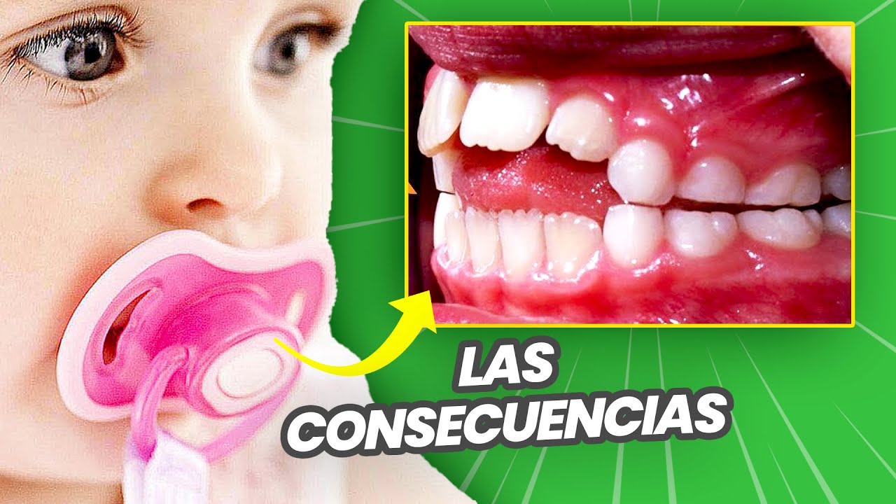 ¿CHUPÓN SI O NO? 🥲 ¿Hasta qué edad? ¿Es malo? Las CONSECUENCIAS del uso prolongado del CHUPETE 🫣