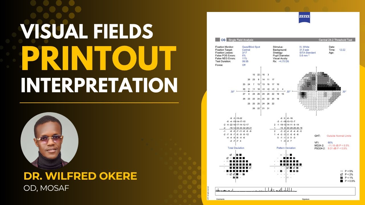 Visual Field Printout Interpretation | Full Tutorial on CVF Analysis