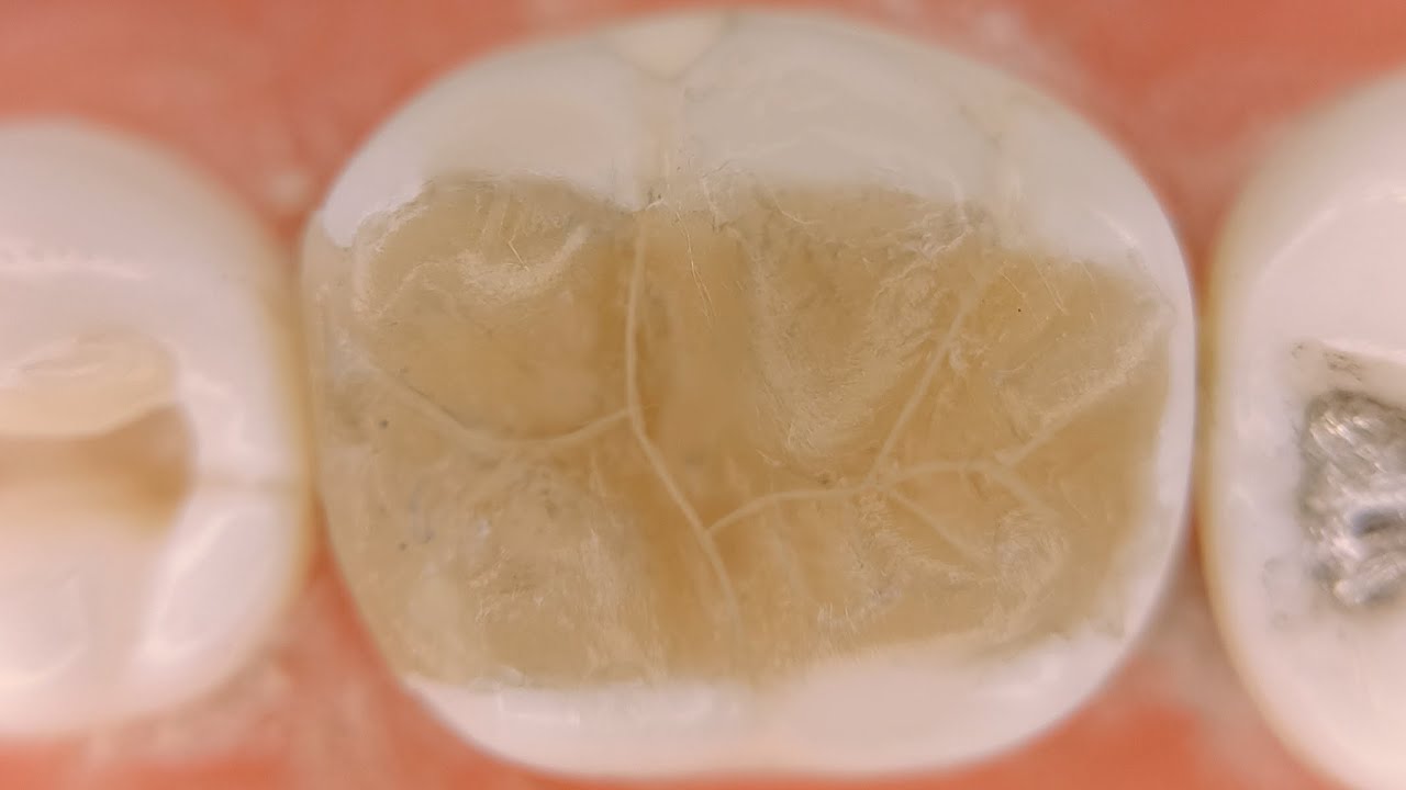 Class II lower 6 composite filling restoration