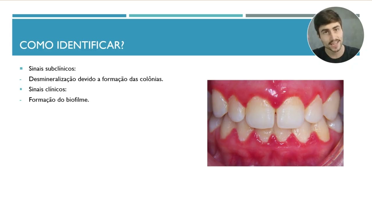 Cariologia Descomplicada: Diagnóstico e Tratamento de Cárie