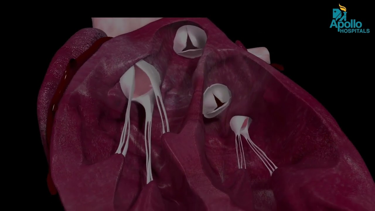 What Is Heart Valve Repair? | Doctor Explains Simply
