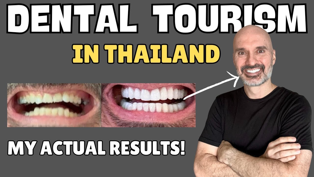Мне поставили 22 коронки и 6 виниров в Таиланде. 🇹🇭 ШОКИРУЮЩЕЕ преображение в стиле стоматологиче...