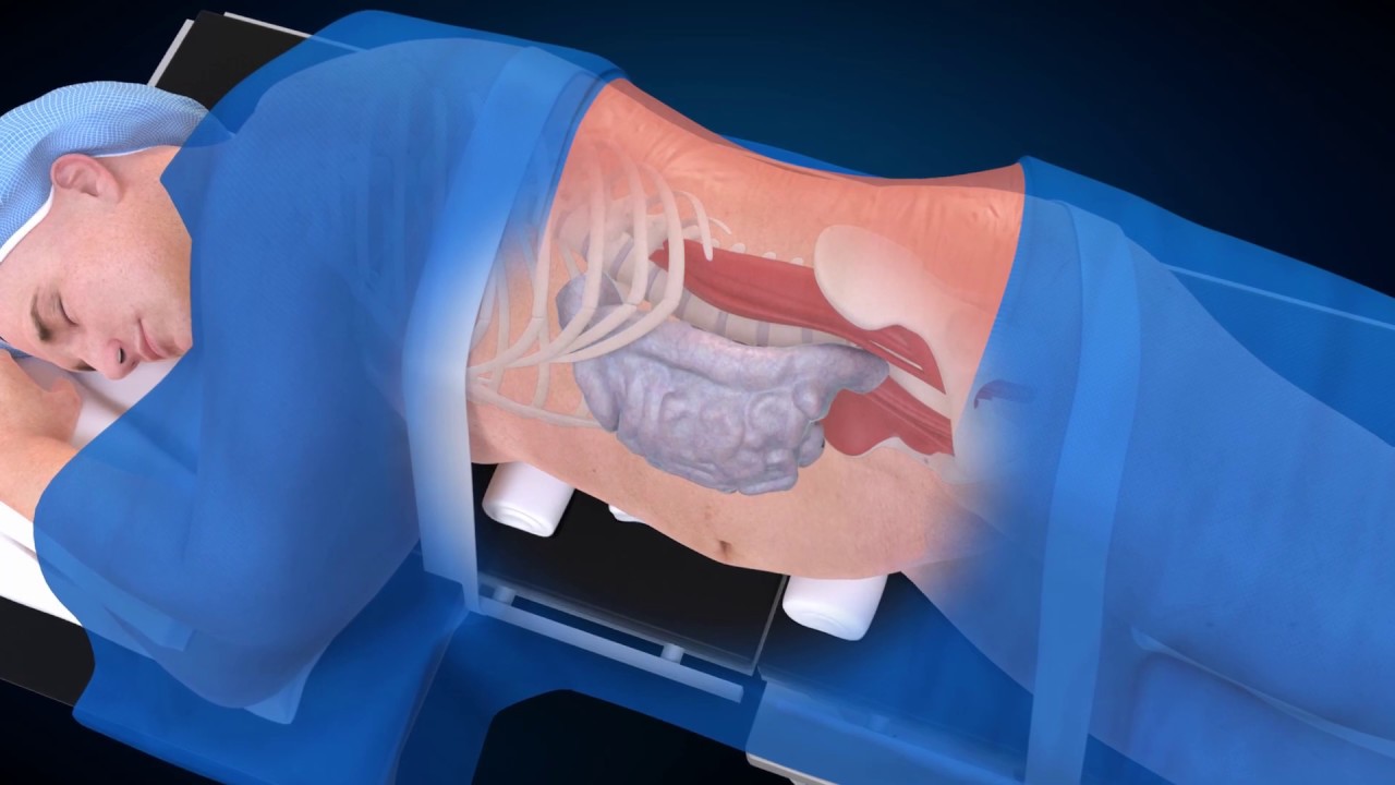 Medtronic: OLIF25 Procedure (Spine Animation)