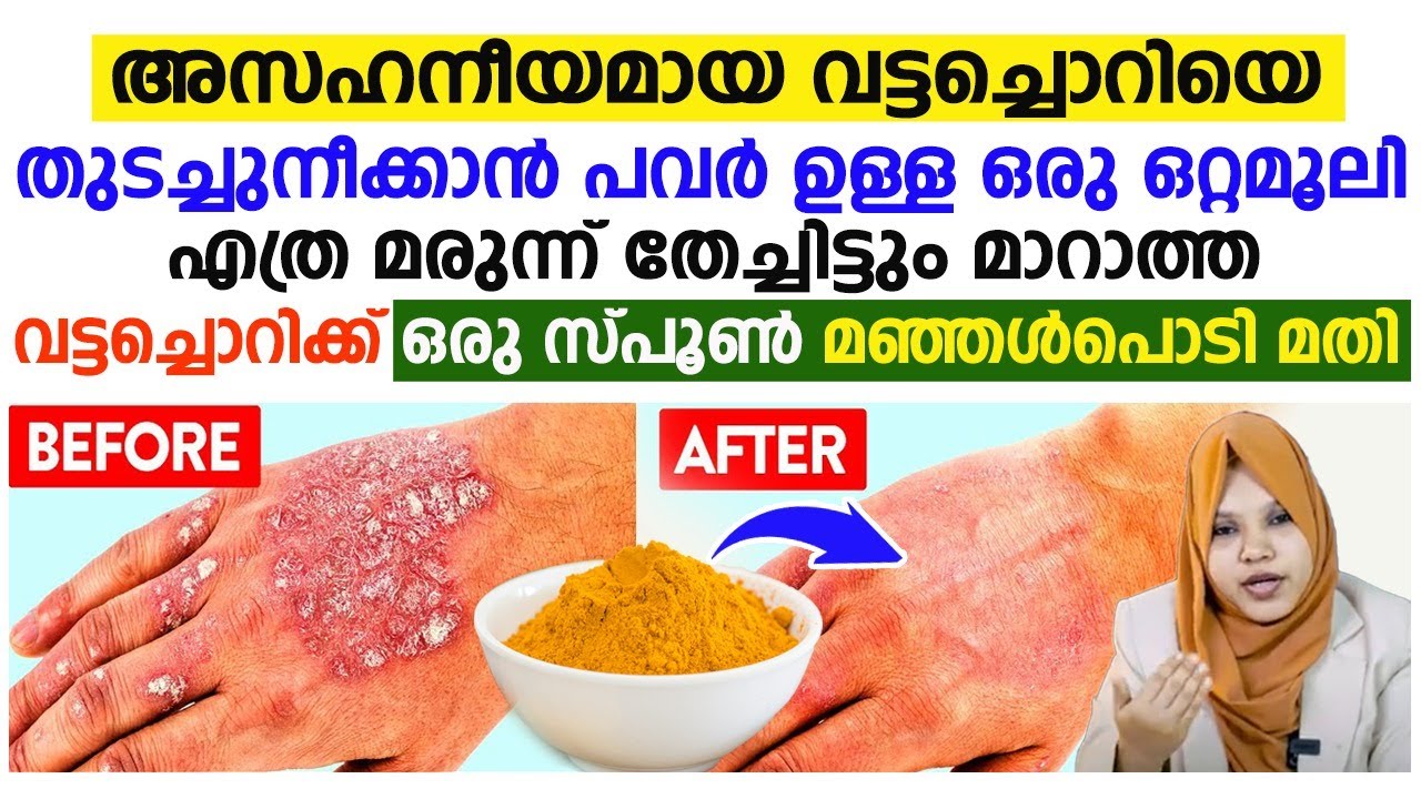 അസഹനീയമായി വട്ടച്ചൊറിയെ പൂർണമായി മാറ്റാൻ ഒരു സ്പൂൺ മഞ്ഞൾപൊടി മാത്രം മതി