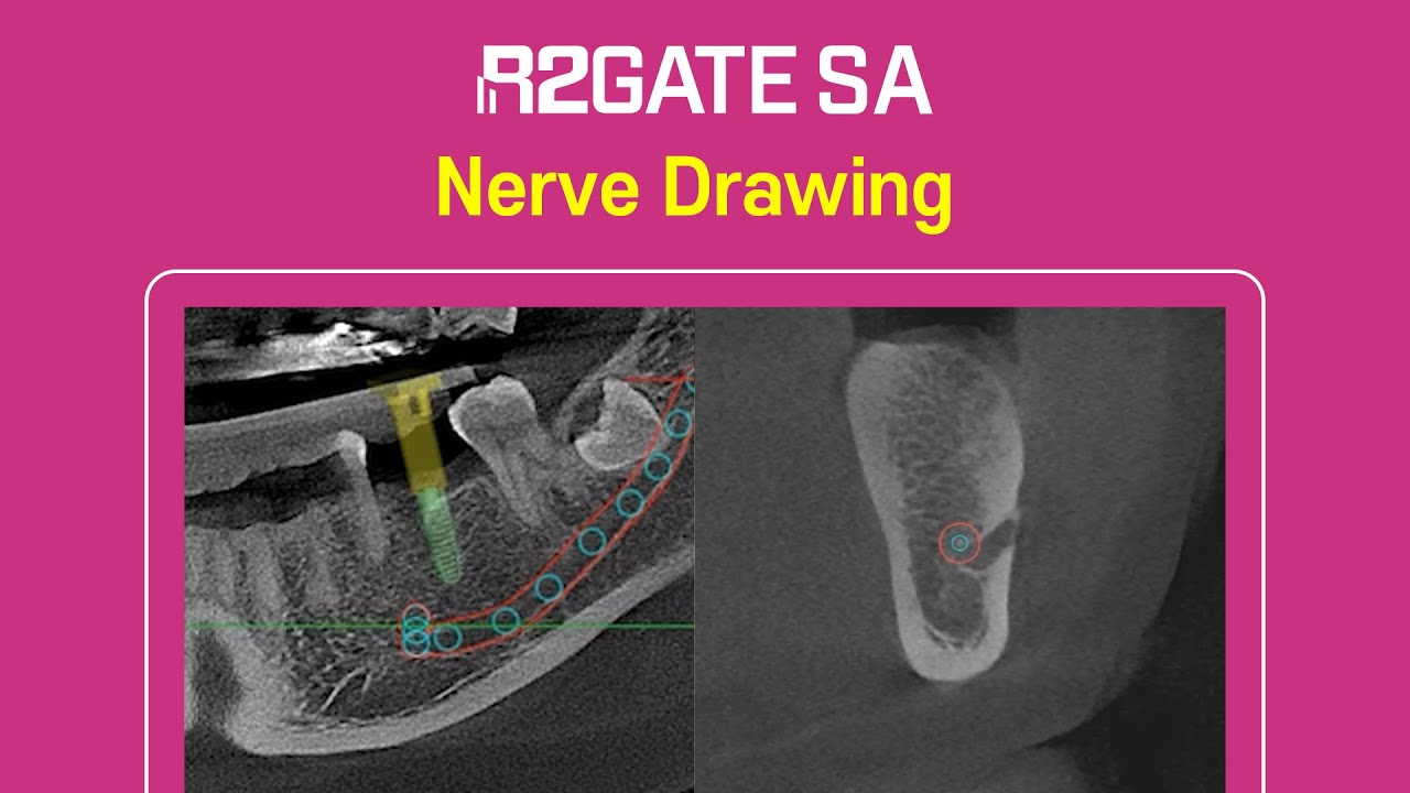 R2GATE SA Tutorial Series | Step 5: Mandibular nerve drawing