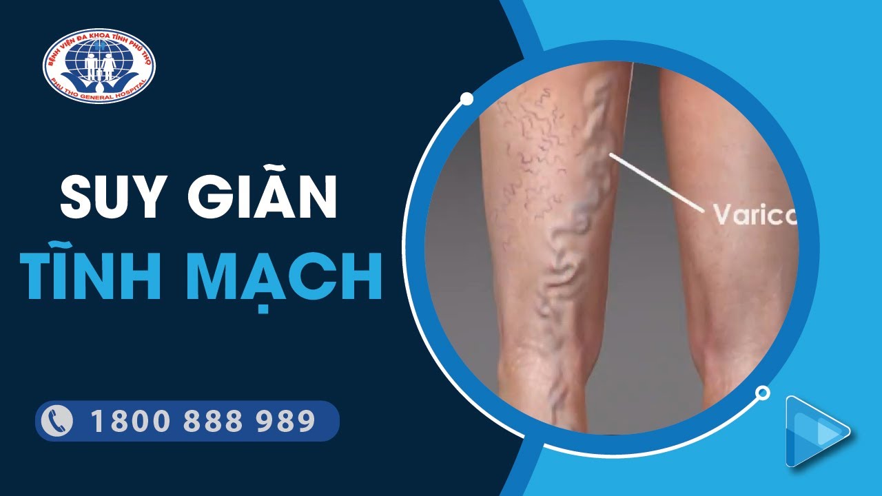 Điều trị suy giãn tĩnh mạch chi dưới - Thạc sĩ Bác sĩ Nguyễn Thị Cẩm Bình - Trung tâm Tim mạch