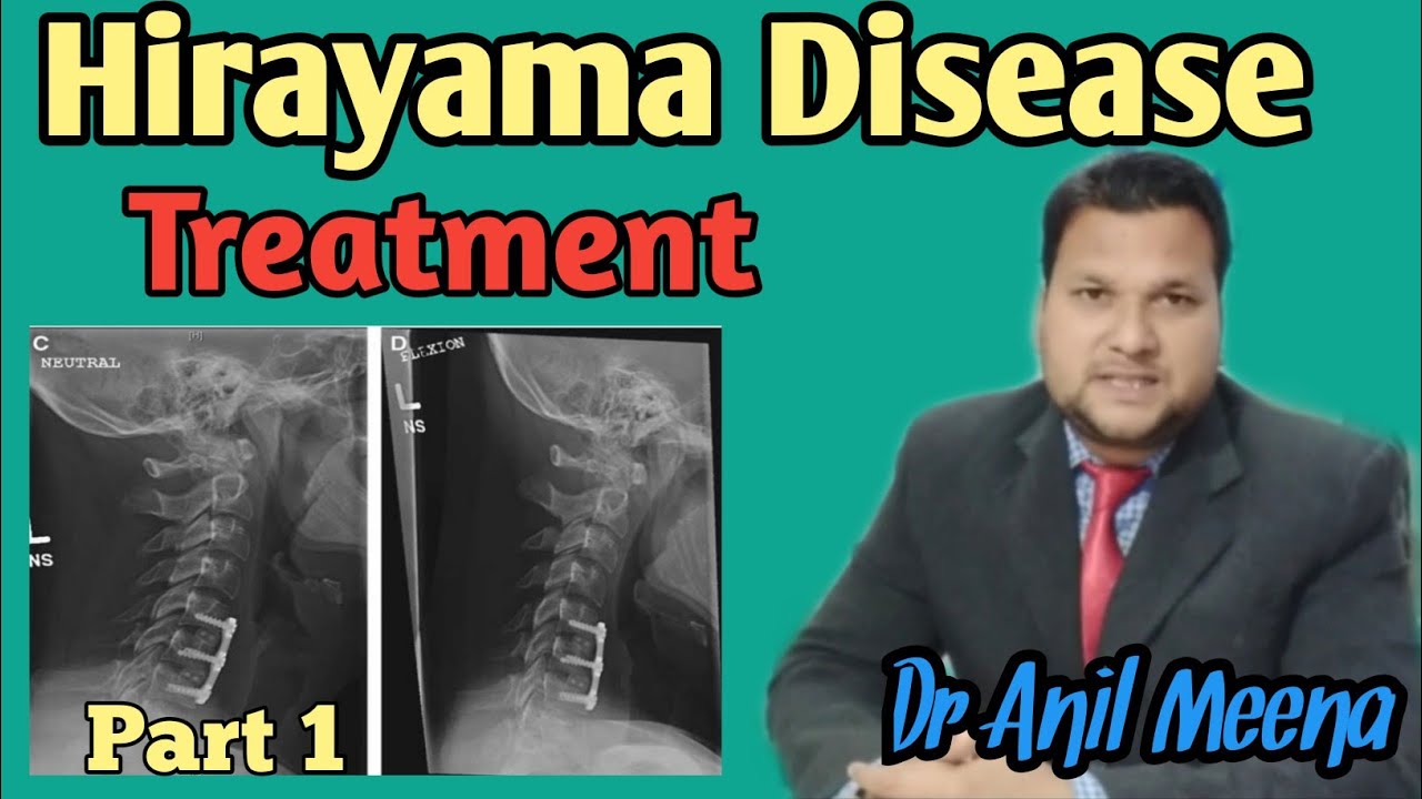 Hirayama Disease | hirayama Disease Treatment | Hirayama Disease Treatment and Exercise | in Hindi