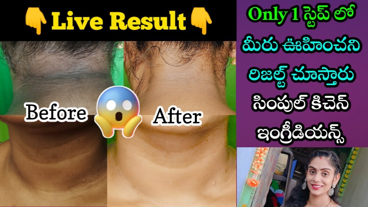 Only 1 స్టెప్ లో మీరు ఊహించని రిజల్ట్ చూస్తారు | How To Get Rid Of Dark Neck Fast😍 In Telugu | geeta
