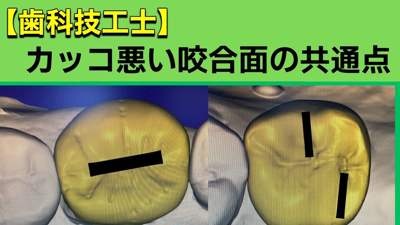 【歯科技工士】カッコイイ咬合面の作り方