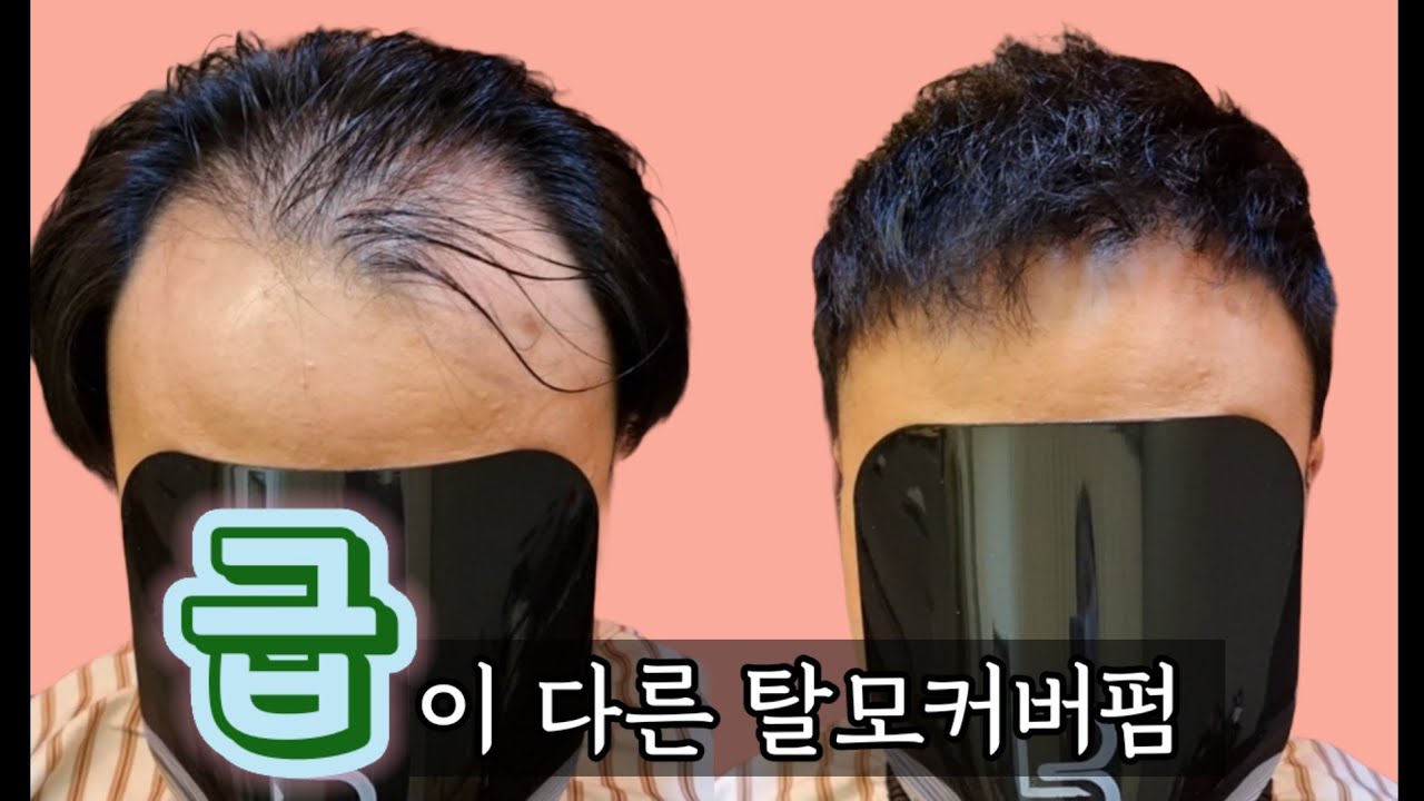 남자 탈모 펌 탈모바버샵 넓은이마 앞머리 탈모커버펌 탈모헤어스타일