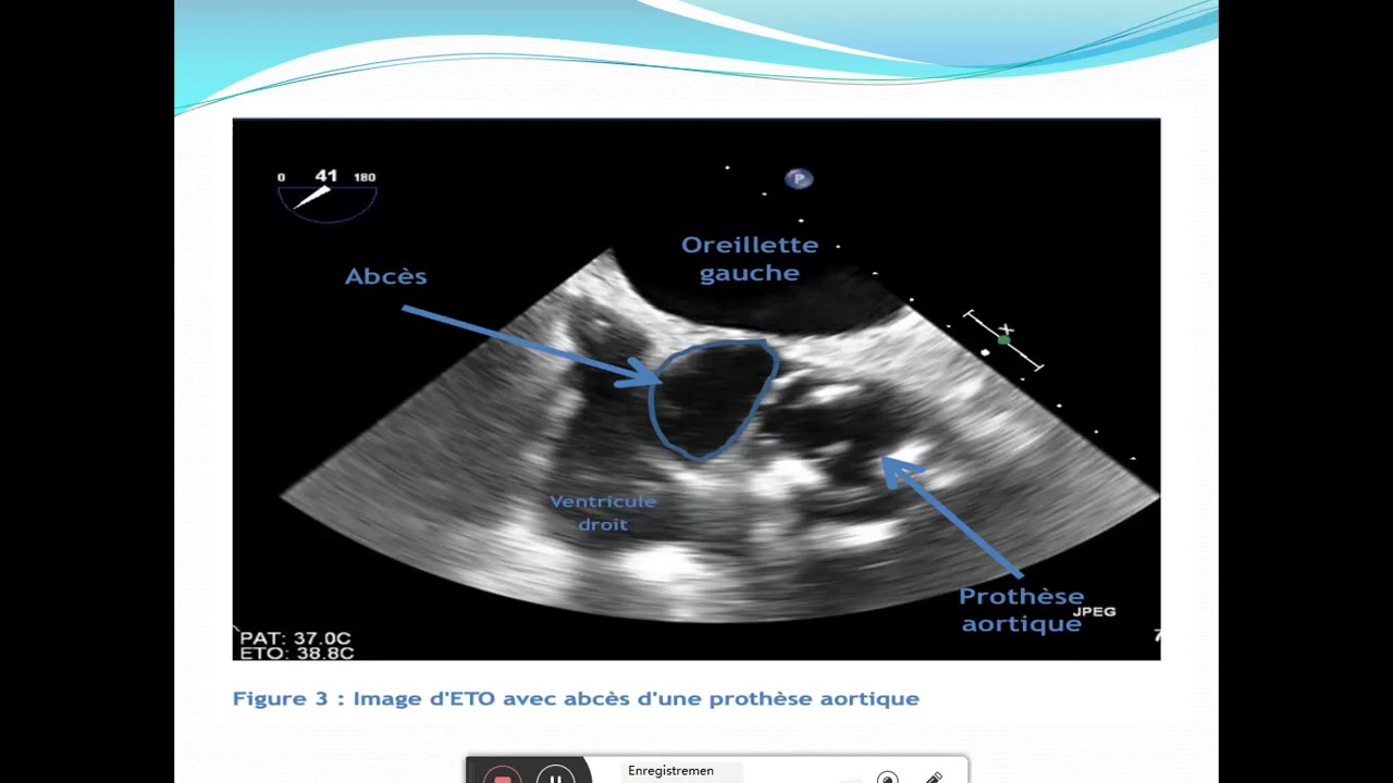 endocardite bacterienne Dr SEDDIKI