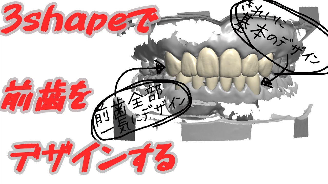 【歯科技工】3Shapeで前歯をデザインしてみた。しかも上下一緒に！ジルコニアクラウンがどうやってできるかみんなにも見てほしい。変な患者さんが来ました第4話