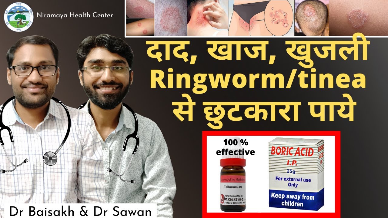 dad khaj khujli ki dawa- Homeopathic medicine for ringworm/fungal infection/tinea infection