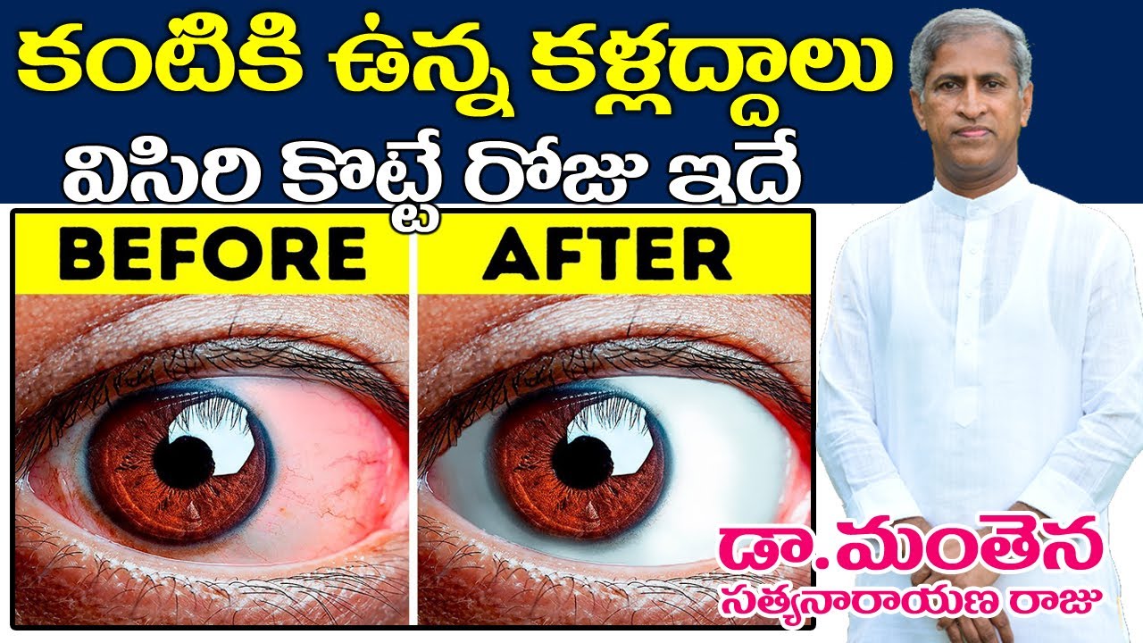 Avoid Eye Sight Totally | కంటికి ఉన్న కళ్లద్దాలు విసిరిగొట్టే రోజు! | Dr Manthena Satyanarayana Raju