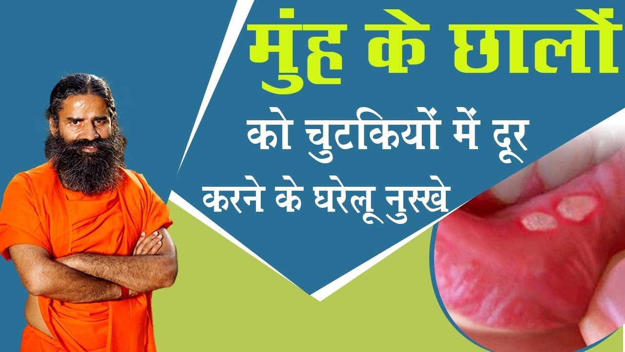 मुंह के छालों को चुटकियों में दूर करने के घरेलू नुस्खे | Swami Ramdev